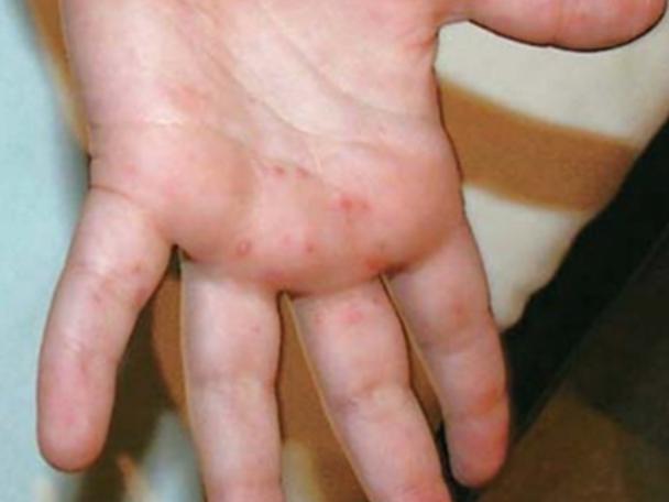 感染手足口病毒后手部长红色的丘疹