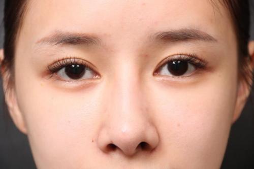 view韩国鼻子修复手术隆鼻出现这些问题怎么办