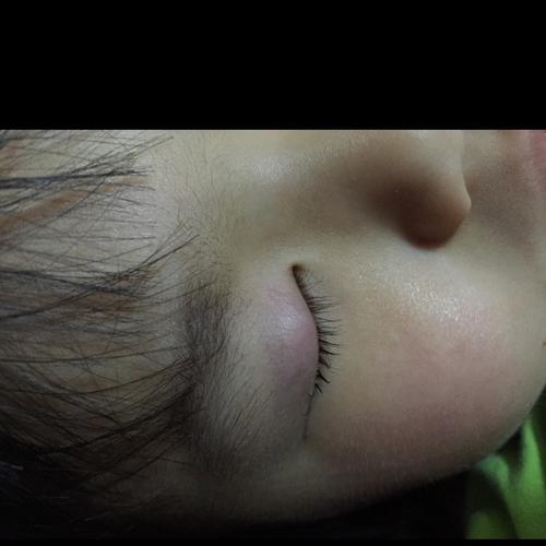 女宝宝2岁半,右眼上眼皮里面长了一个包,睡着后从表面看很明显,去医院