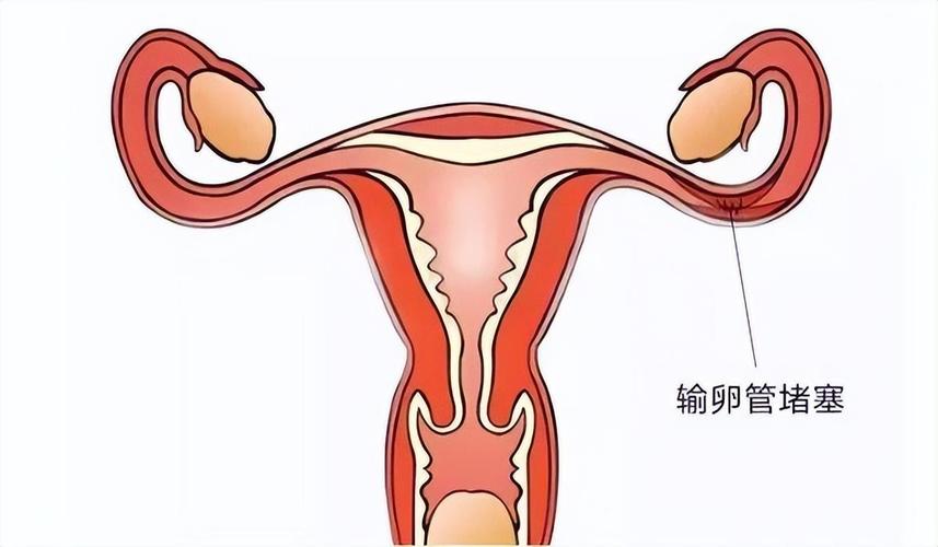 输卵管堵塞有什么样症状