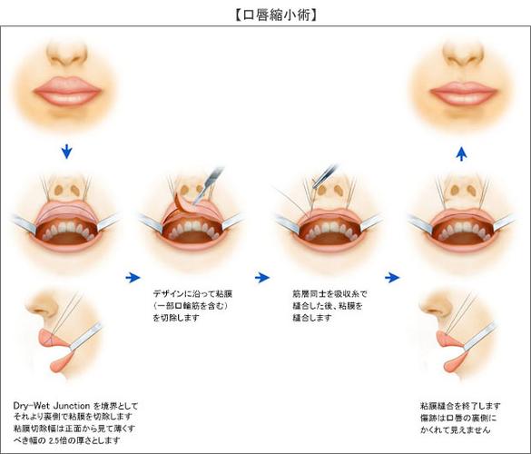 自体脂肪丰唇 从自身提取脂肪,然后注射到唇部,术后恢复期较长,但维持