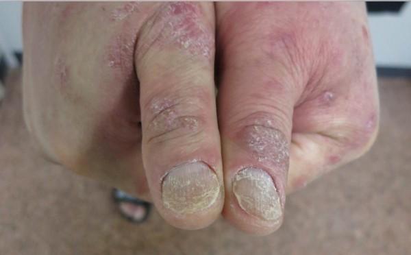 指甲也会生病,指甲泛黄原来是"干癣性关节炎"