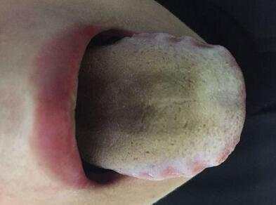 舌苔颜色暗示疾病发黄肝火旺发黑多为慢性病
