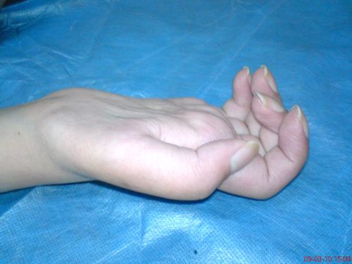 上臂离断术后一年,爪形手畸形,拇指对掌功能障碍