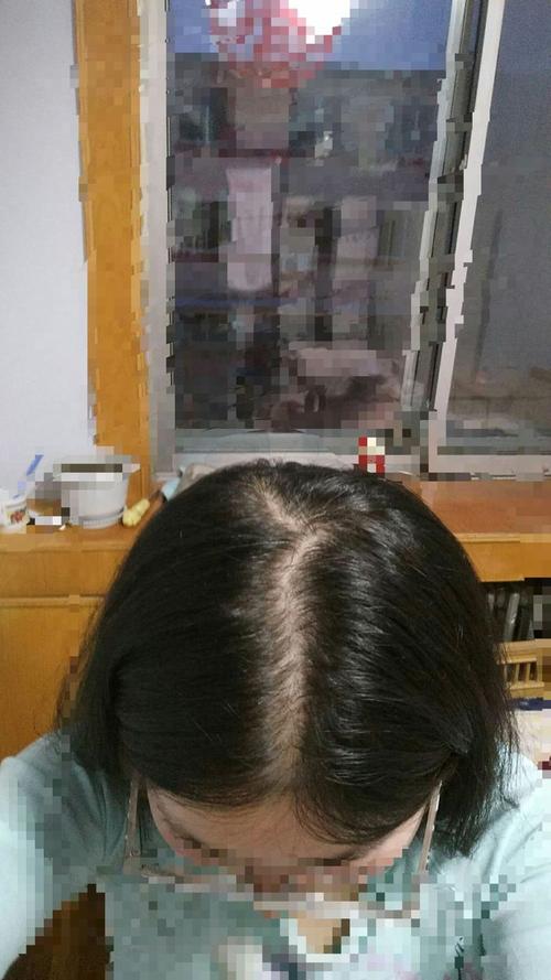 女24岁,求大神看一下我这是什么类型的脱发?可以怎样改善?拜托拜托?