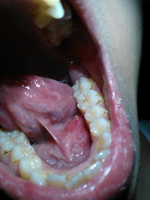 舌下肉阜痛 舌下肉阜一侧肿大-图片大观-奇异网