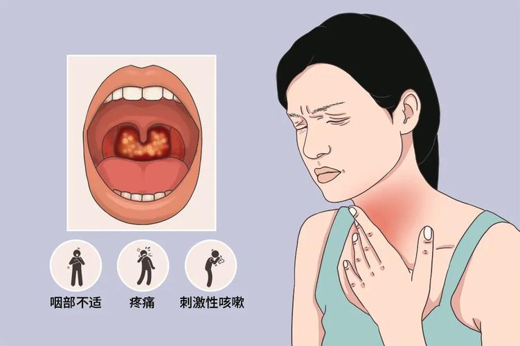 甲流乙流后攻击嗓子的咽喉炎近期大肆流行咽喉炎有哪些症状应当如何
