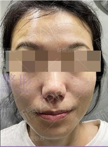 患者术前的鼻子,鼻翼组织肥厚,鼻翼外扩导致的鼻翼宽_圈子-新氧美容