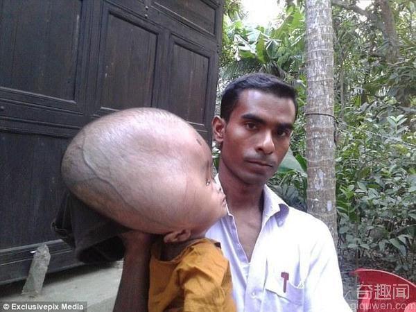 孟加拉2岁男孩患脑积水脑袋是同龄孩子的三倍