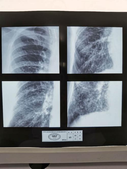 职业病尘肺标准片(照片)