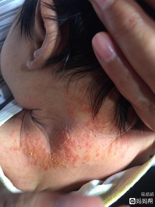 发热12天内即可出疹,一般由面部蔓延到躯干和四肢,往往第一天出疹子即