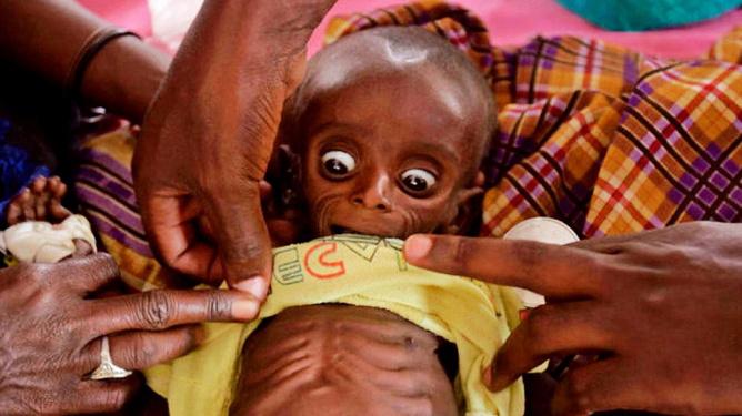 索马里饥荒很多孩子脑袋很大身体却瘦成皮包骨