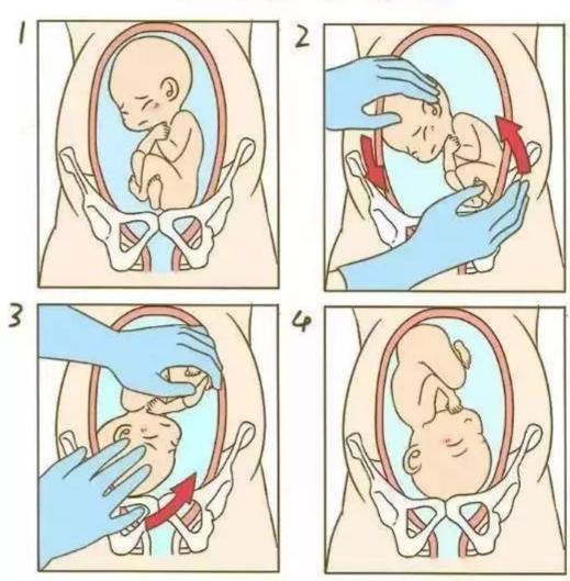 "外倒转"是经腹壁用手转动胎儿,使不利于分娩的胎位(臀位,横位)转成有