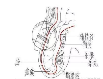 疝气如何治疗腹股沟疝,诏安本地俗称"小肠风",是腹腔内脏器(如小肠,大