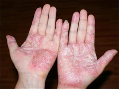 手足癣是常见的一种皮肤病之一,致病菌主要是毛癣菌属和表皮癣菌属.