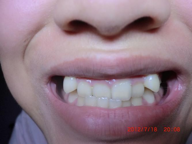 【牙齿反颌】 5 2010-12-13 如何纠正幼儿反颌(地包天)问题 2 2010-09