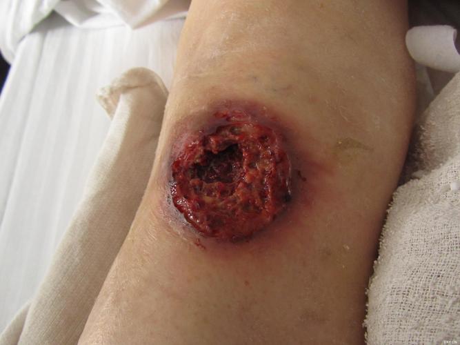 膝关节皮肤表面有一浅表破口,常规换药并预防使用二代抗生素.