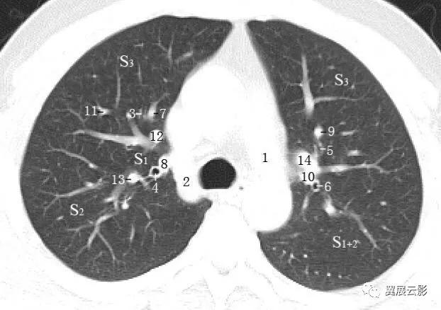 完美标注肺部横断面解剖肺门肺段及血管解剖