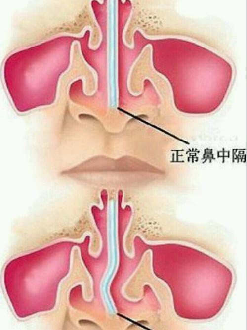 什么是鼻中隔手术?