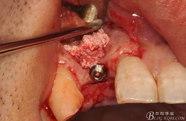 前牙钛网植骨同期种植手术详解王汉禹