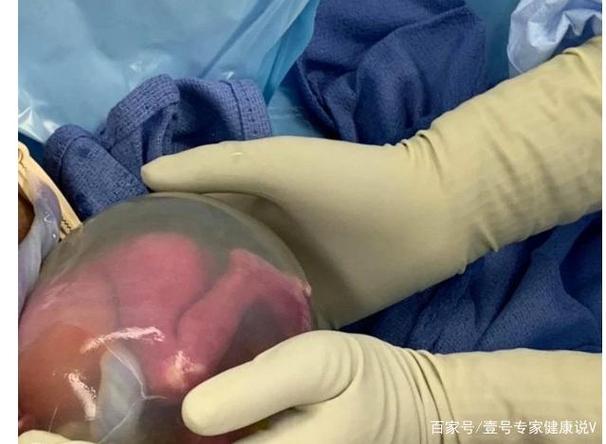 奇迹!美国一对22周的早产双胞胎活了下来,出生时还裹在羊膜里