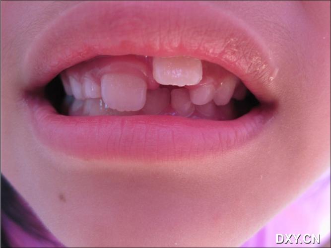 【求助】乳牙滞留,导致后继恒牙错位萌出