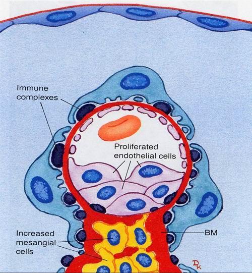 【资料】毛细血管内增生性肾小球肾炎病理图片
