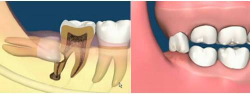 我们所说的智齿,也就是第三磨牙或_圈子-新氧美容整形