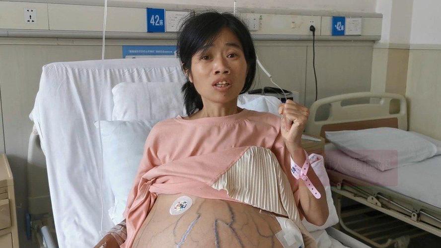 贵州肚大如箩女子已入院治疗:初步诊断为晚期卵巢癌合并肝硬化