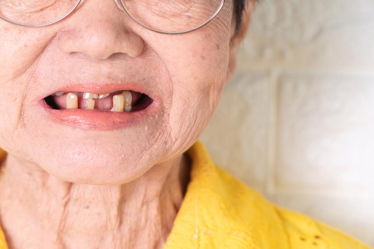 牙齿数量决定一个人的寿命?60岁后,牙齿应该剩多少?告诉你答案
