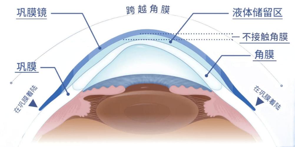 湖北省首例艾康菲巩膜镜验配成功,张明昌教授团队帮助患者重获清晰