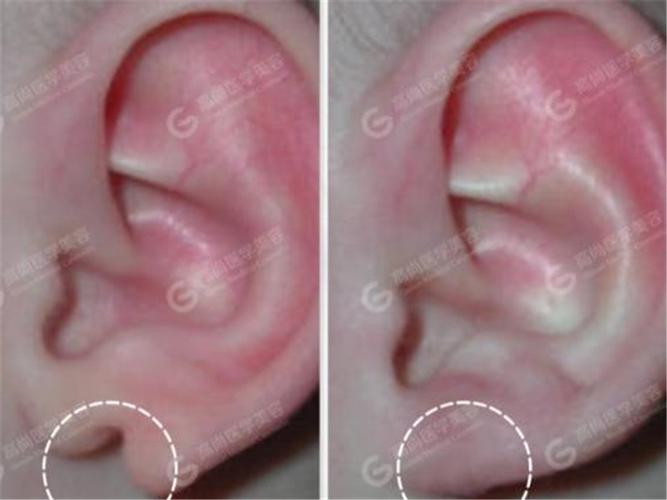 如何判断耳垂是不是畸形?