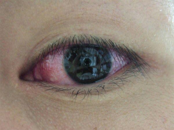 眼睛血丝多就是红眼病吗?