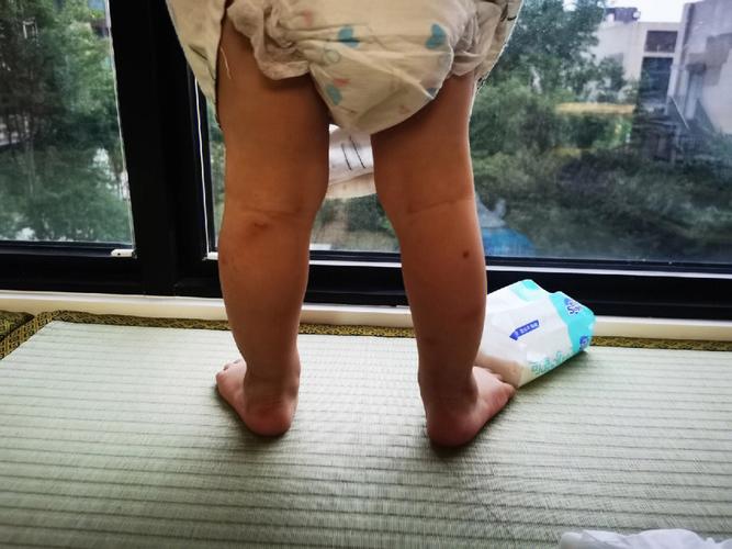 发现宝宝左脚足外翻有一段时间了,但是刚开始不太严重,一直等着15个月