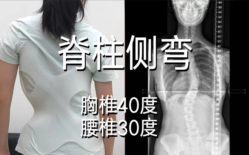 【长期困扰 细节制胜】高中女生脊柱侧弯40度 10个月减少10度