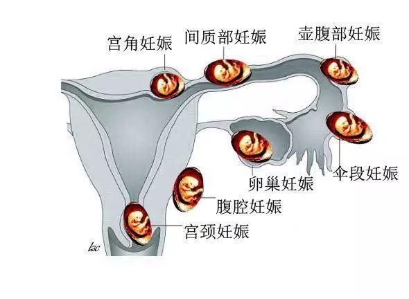抵达宫腔,经过分裂形成胚囊,胚囊外围为滋养层,该层有溶解母体的酵素