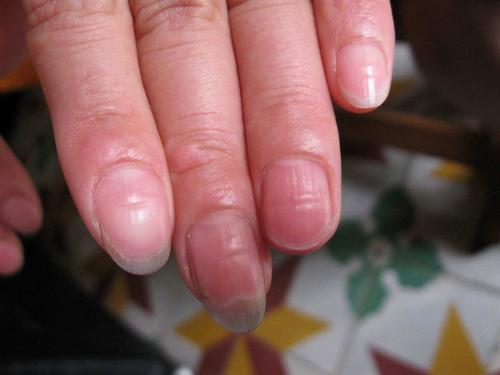 患缺铁性贫血及造成肢端缺血的雷诺氏病,皆可引起指甲凹凸不平症.