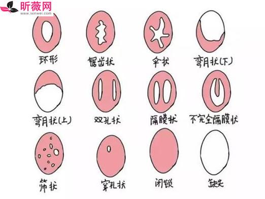 由于阴道瓣形态各异,在撕裂后的破裂程度有很大区别.