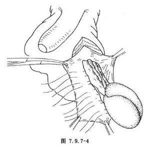 睾丸扭转及其复位固定术