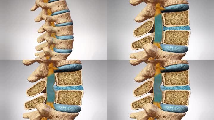 神经压迫 骨质疏松 人体医学 医学研究 腰椎病 腰疼 解剖 3d脊柱 脊柱