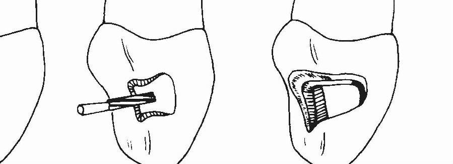 Ⅲ类洞的倒凹固位形一般做在靠近切嵴和龈壁与颊侧壁,舌或腭侧壁交界