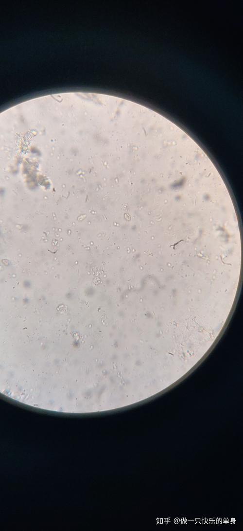 白带常规镜检图霉菌