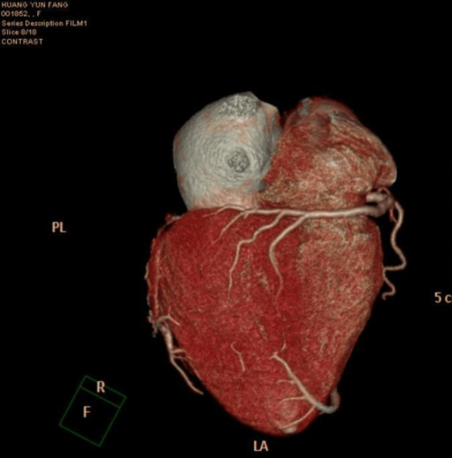 3d心脏图片 冠状动脉 医学影像三维重建系统 影像技术 影像医学