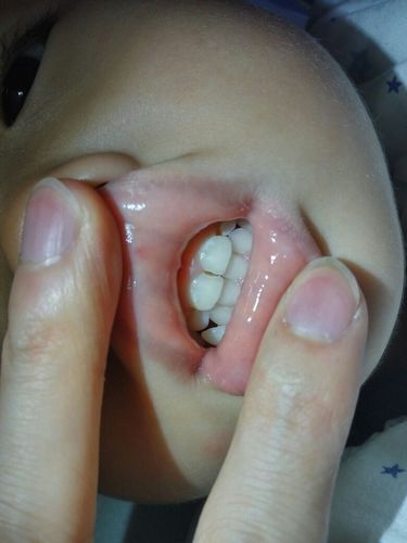 两周岁半的宝宝牙齿的牙釉质有损坏,这是龋齿了吗?还有的救吗?