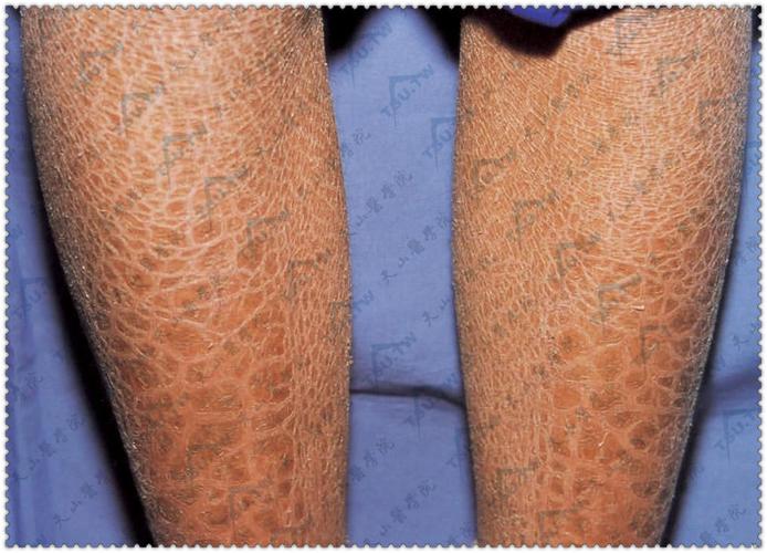 寻常型鱼鳞病(干皮病)症状:四肢伸侧皮肤干燥,出现淡褐至深褐色菱形