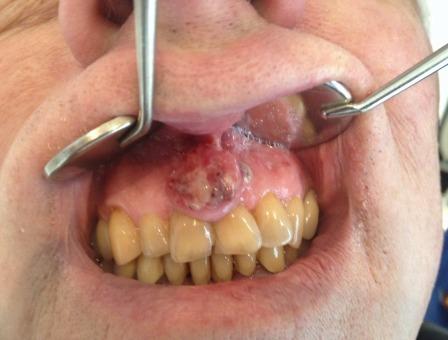 stephanie等发现了首例发生在口腔内侵袭牙龈的原发性皮脂腺癌,病例