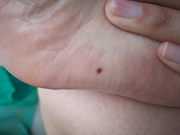 脚底长了一个黑色的痦子,这是不是黑色素瘤,好害怕呀,而且我的指甲上