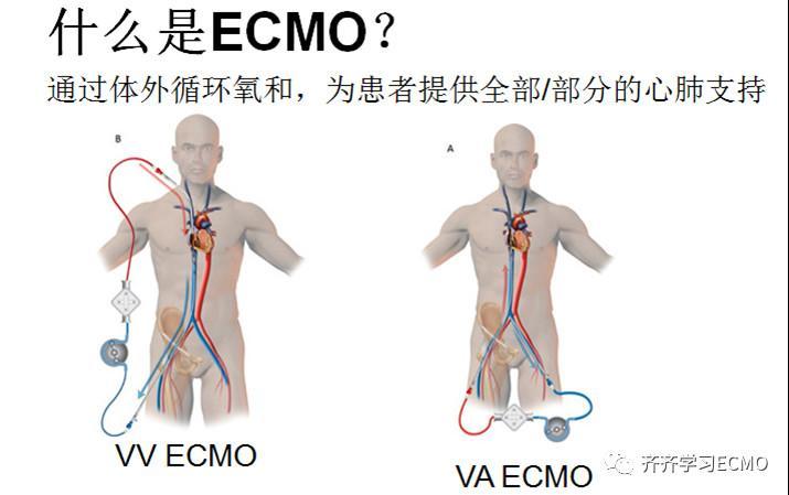 什么是体外膜肺氧合ecmo