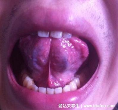 舌下血管瘤早期图片及症状,初期舌头上有紫红色的柔软肿物