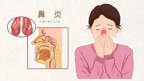 鼻炎的本质是体质变弱了别再让气温和花粉背锅了